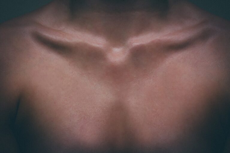Photo thyroid autoimmune